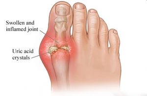 Homeopathic Treatment for Gout1