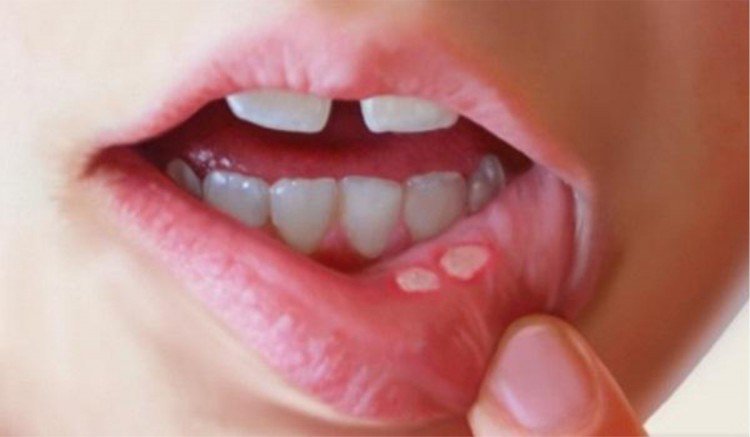 Homeopathic Treatment for Mouth Ulcers or Canker Sores