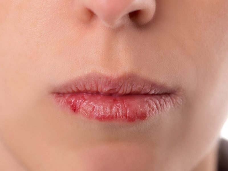 homeopathic remedies for dry mouth