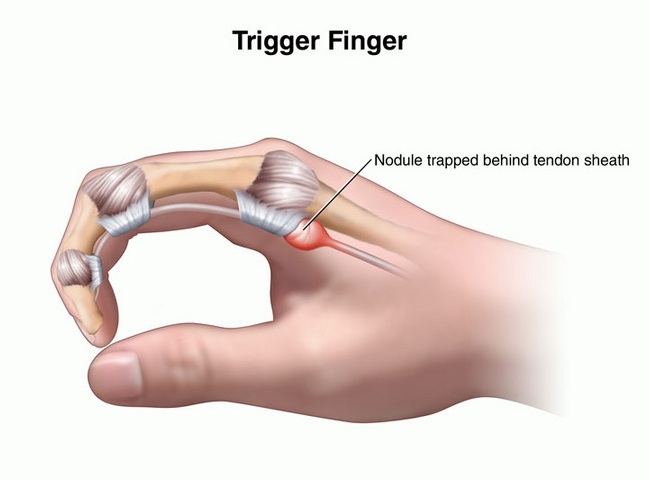 Homeopathic Medicine for Trigger Finger