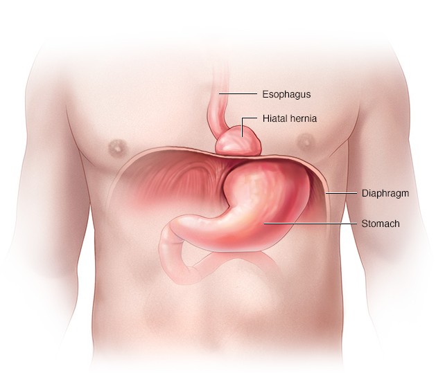 Homeopathic Medicine for Hiatus Hernia