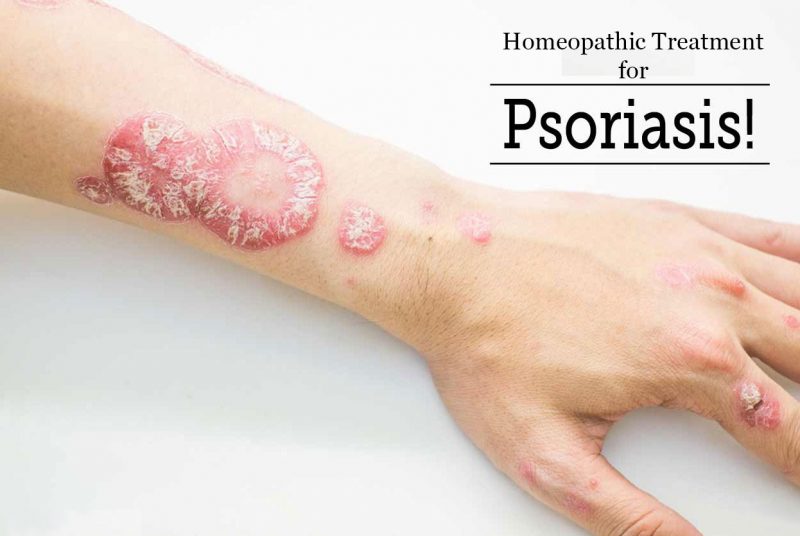 Homeopathic Medicine for Psoriasis