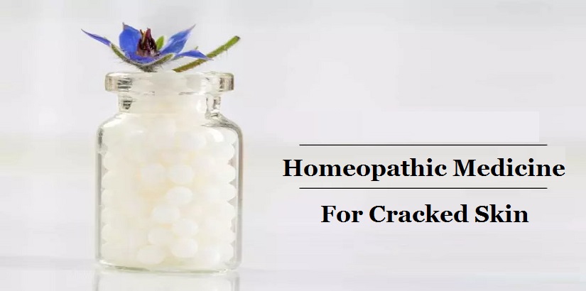 homoeopathic medicine for cracked heels