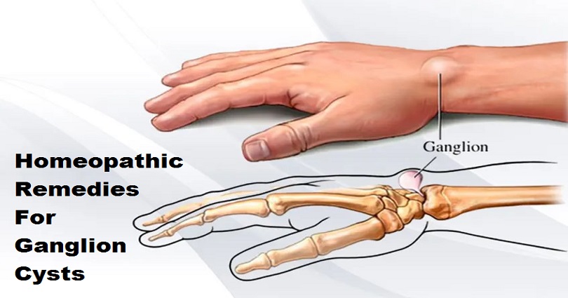 Homeopathic Remedies for Ganglion Cysts Treatment