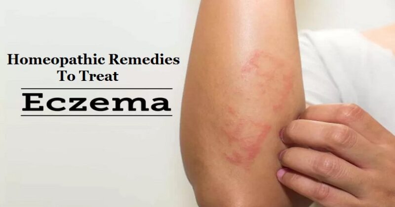 homeopathic remedies for eczema
