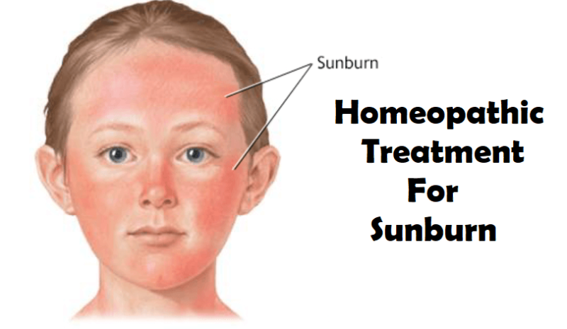 Homeopathic Treatment for Sunburn