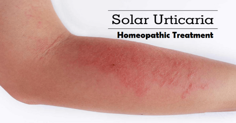 homeopathic medicine for solar urticaria
