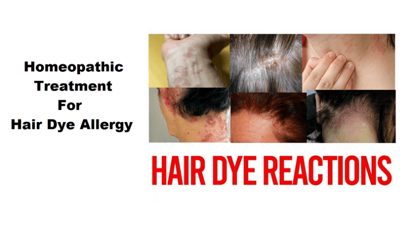 homeopathic medicines for hair dye allergy